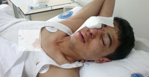 Polis Gaz Fişeğiyle Vurdu, Gözünü Kaybetti