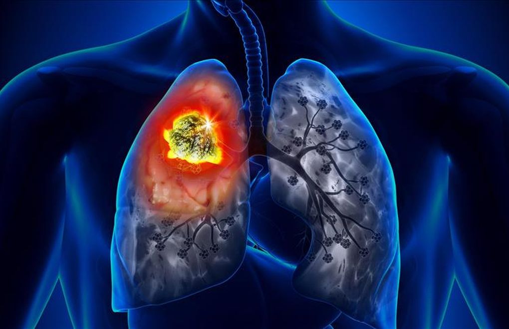 Türkiye akciğer kanseri en çok görülen 10 ülke arasında